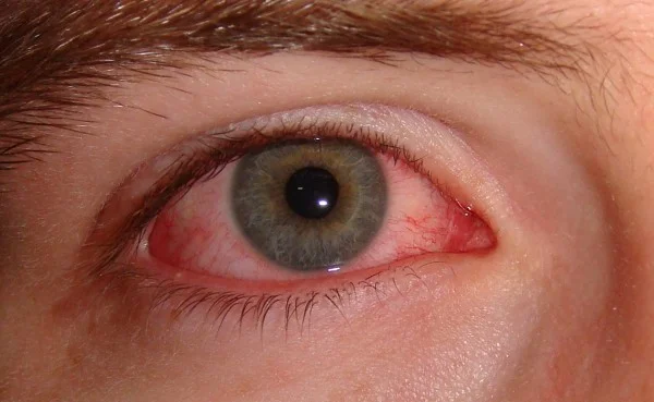 Symptoms and Treatments of Pink Eye (Conjunctivitis)