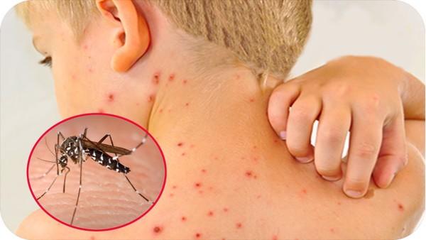 The Severe Impact of Dengue Fever